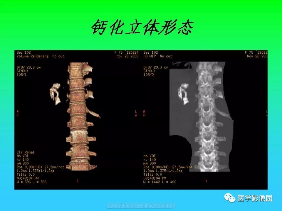 【病例】肝脏孤立性纤维瘤1例CT影像表现