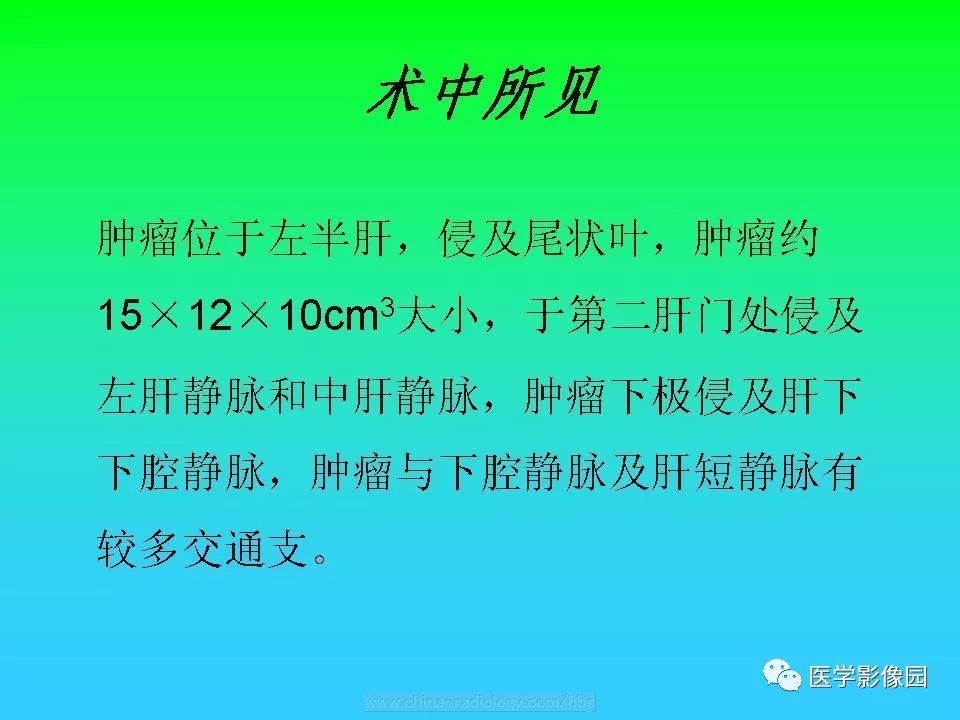 【病例】肝脏孤立性纤维瘤1例CT影像表现