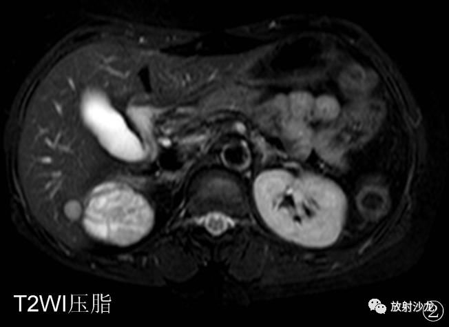 【病例】后肾腺瘤MA一例MR影像表现 【病例】后肾腺瘤MA一例MR影像表现