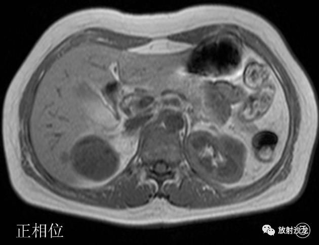 【病例】后肾腺瘤MA一例MR影像表现 【病例】后肾腺瘤MA一例MR影像表现