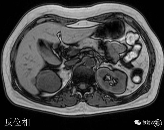 【病例】后肾腺瘤MA一例MR影像表现 【病例】后肾腺瘤MA一例MR影像表现