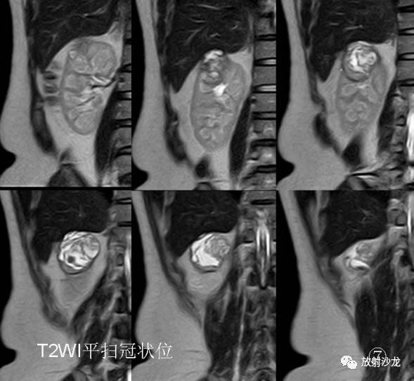 【病例】后肾腺瘤MA一例MR影像表现 【病例】后肾腺瘤MA一例MR影像表现