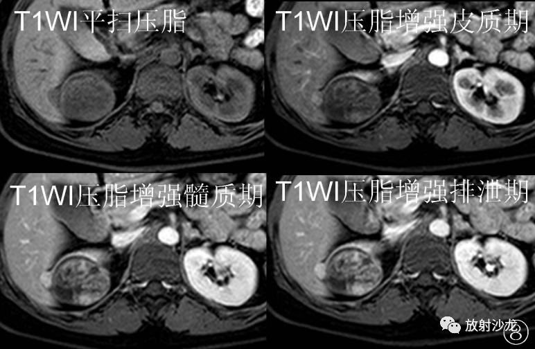 【病例】后肾腺瘤MA一例MR影像表现 【病例】后肾腺瘤MA一例MR影像表现