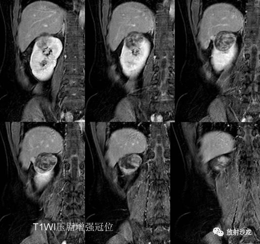 【病例】后肾腺瘤MA一例MR影像表现 【病例】后肾腺瘤MA一例MR影像表现