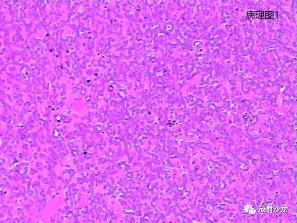 【病例】后肾腺瘤MA一例MR影像表现 【病例】后肾腺瘤MA一例MR影像表现