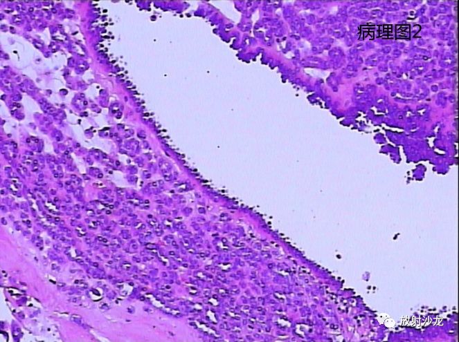 【病例】后肾腺瘤MA一例MR影像表现 【病例】后肾腺瘤MA一例MR影像表现