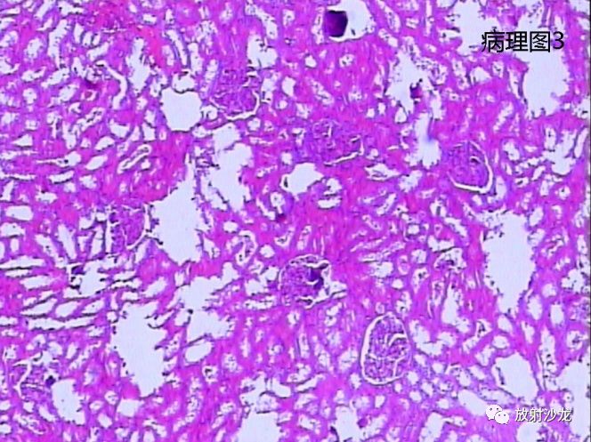 【病例】后肾腺瘤MA一例MR影像表现 【病例】后肾腺瘤MA一例MR影像表现