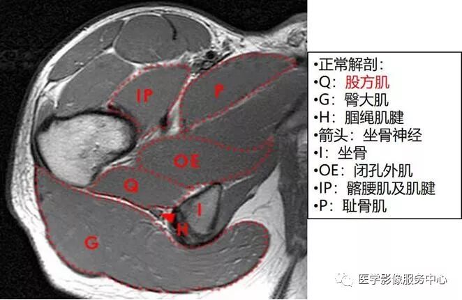掌握这个公式,秒杀坐骨股骨撞击综合征 掌握这个公式,秒杀坐骨股骨撞击综合征