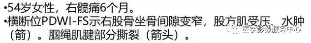 掌握这个公式,秒杀坐骨股骨撞击综合征 掌握这个公式,秒杀坐骨股骨撞击综合征