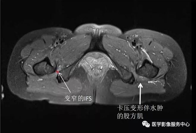 掌握这个公式,秒杀坐骨股骨撞击综合征 掌握这个公式,秒杀坐骨股骨撞击综合征