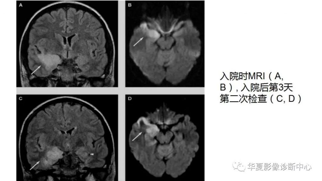 【病例】病毒性脑炎1例MR