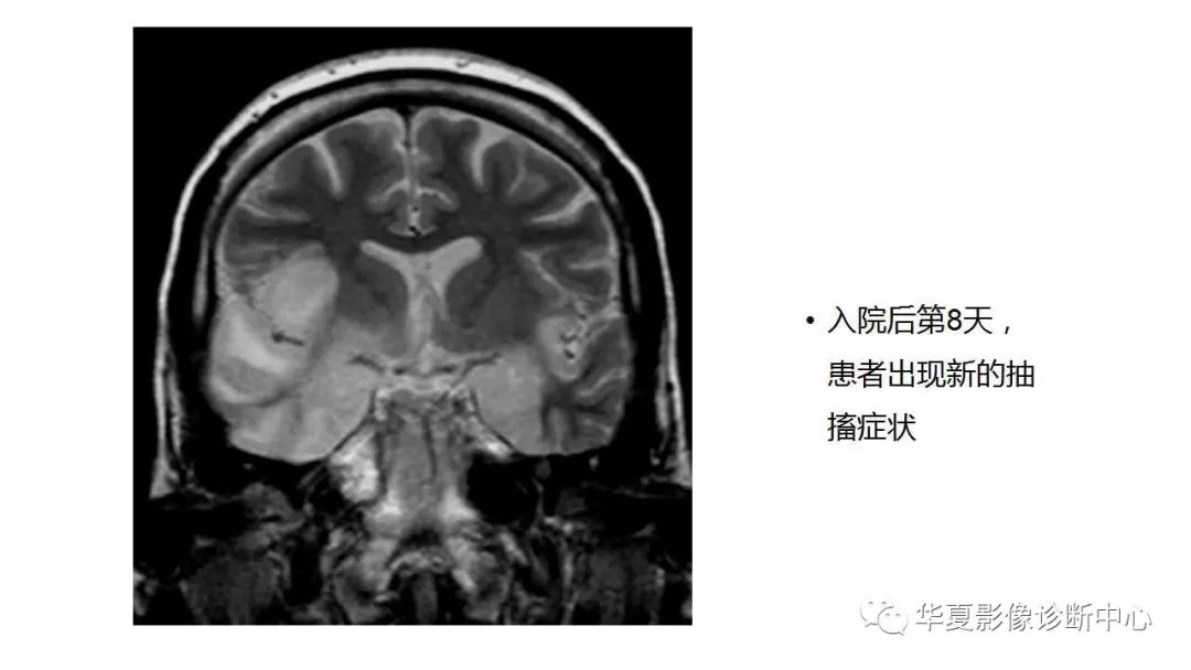 【病例】病毒性脑炎1例MR
