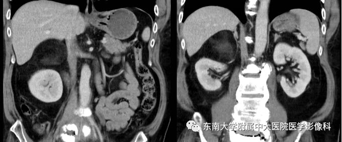 【病例】肾上腺髓脂瘤1例CT影像诊断