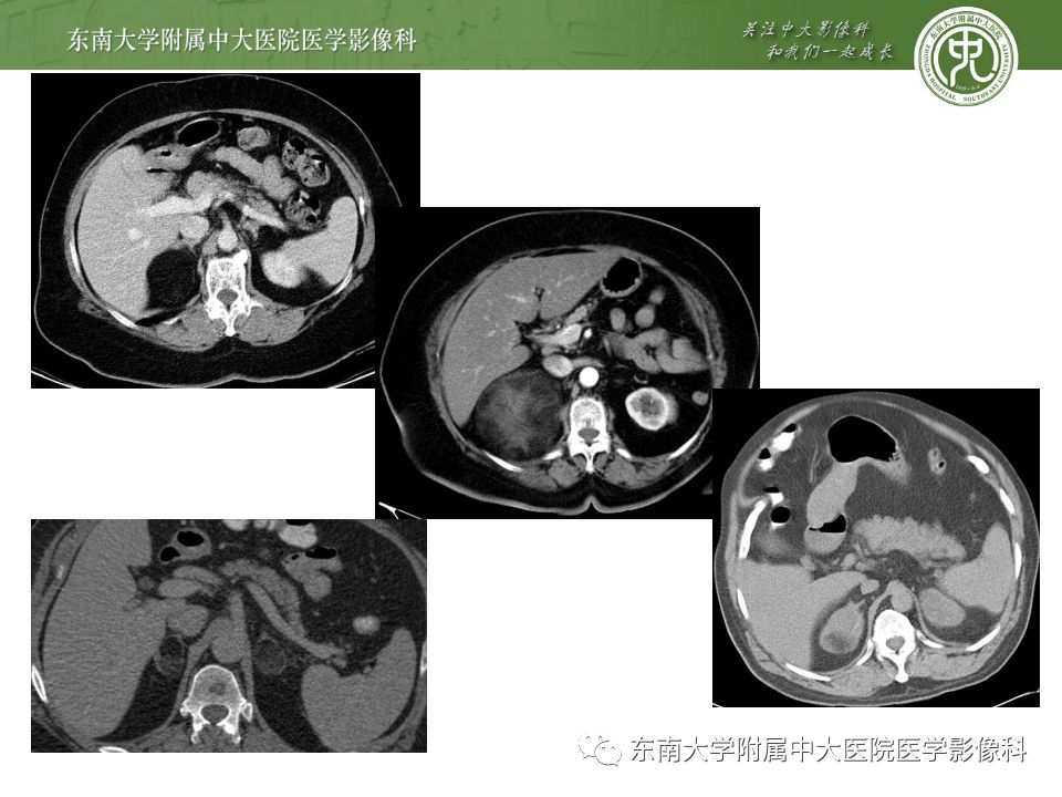 【病例】肾上腺髓脂瘤1例CT影像诊断