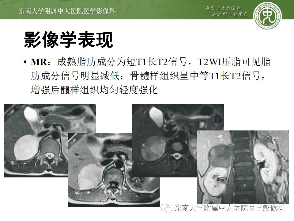 【病例】肾上腺髓脂瘤1例CT影像诊断