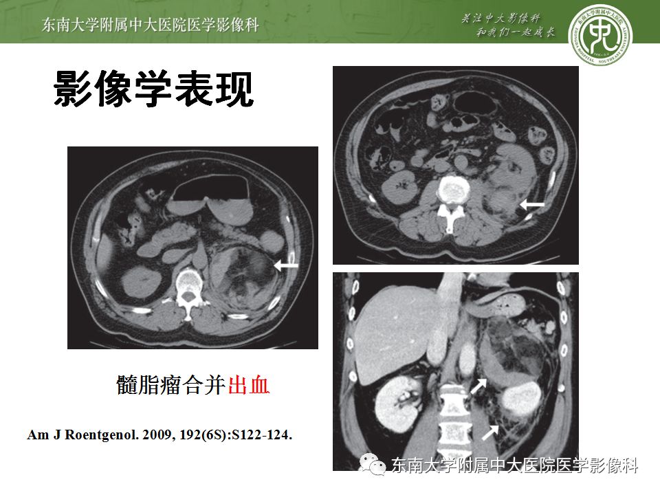 【病例】肾上腺髓脂瘤1例CT影像诊断