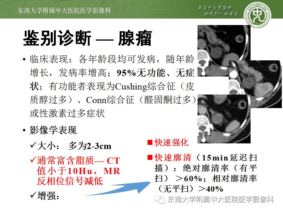 【病例】肾上腺髓脂瘤1例CT影像诊断