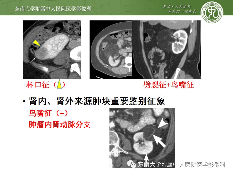 【病例】肾上腺髓脂瘤1例CT影像诊断