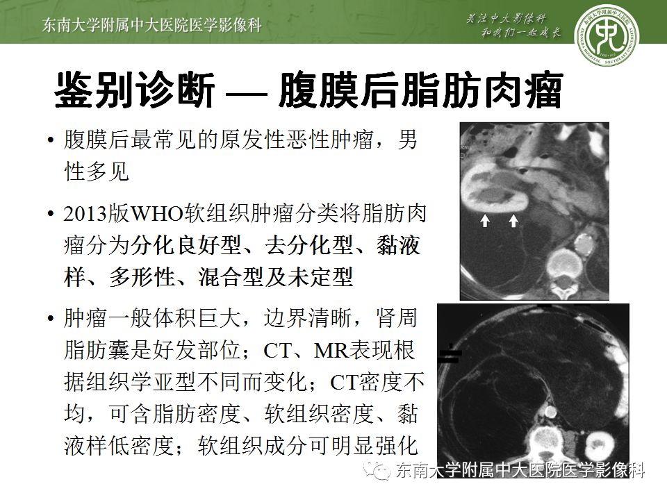 【病例】肾上腺髓脂瘤1例CT影像诊断
