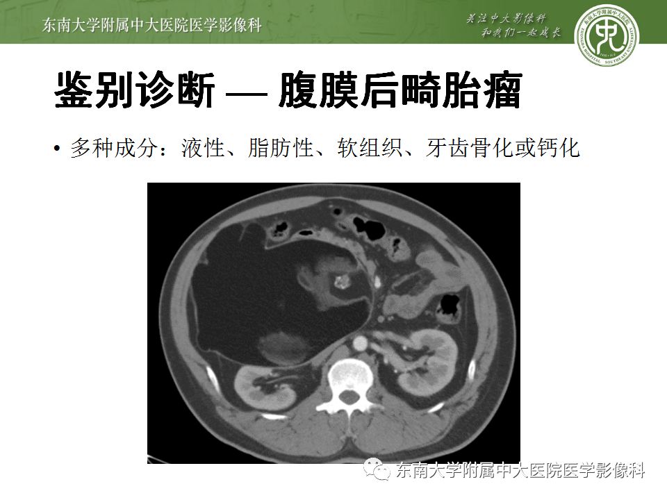 【病例】肾上腺髓脂瘤1例CT影像诊断