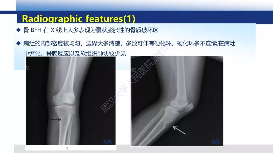 【病例】胫骨良性纤维组织细胞瘤1例X线MR