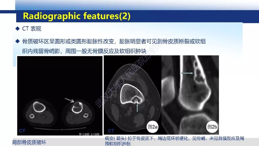 【病例】胫骨良性纤维组织细胞瘤1例X线MR