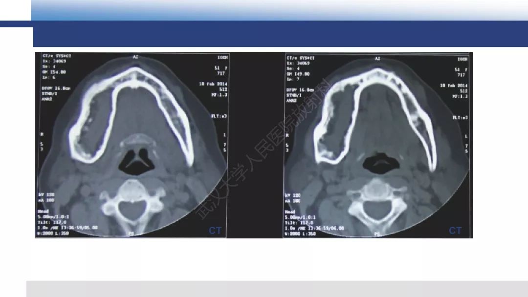【病例】胫骨良性纤维组织细胞瘤1例X线MR