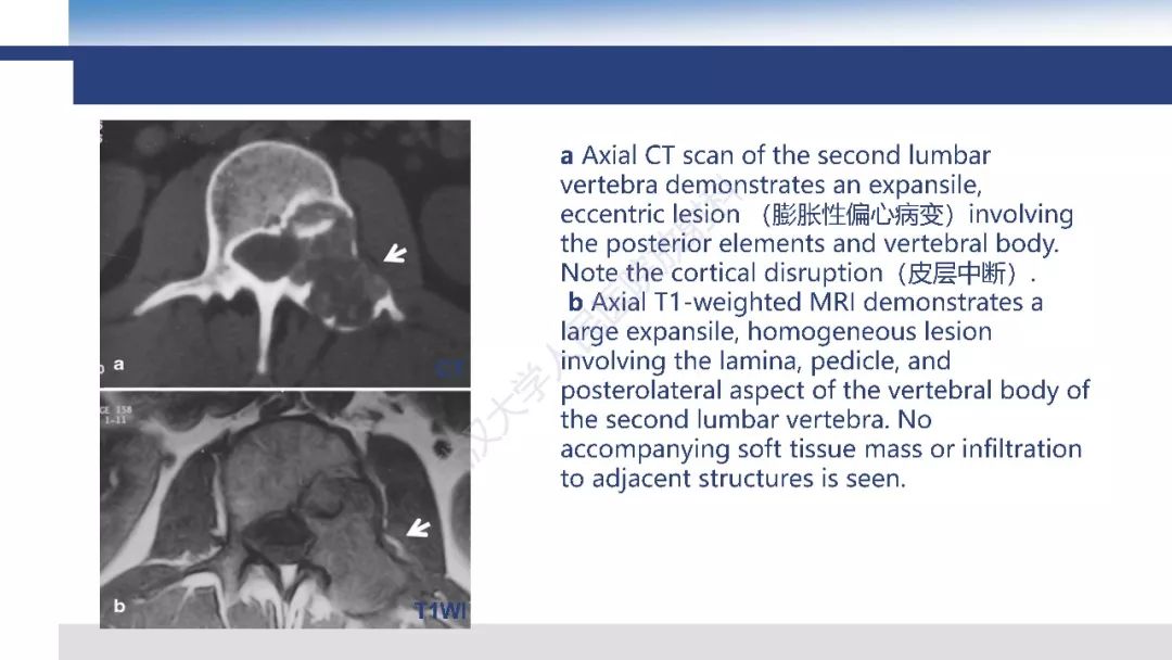 【病例】胫骨良性纤维组织细胞瘤1例X线MR