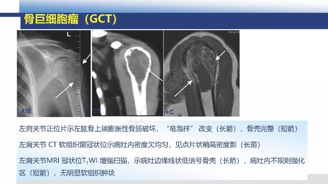 【病例】胫骨良性纤维组织细胞瘤1例X线MR