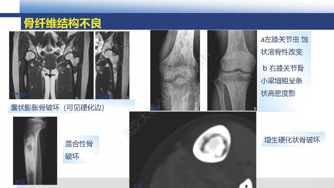 【病例】胫骨良性纤维组织细胞瘤1例X线MR