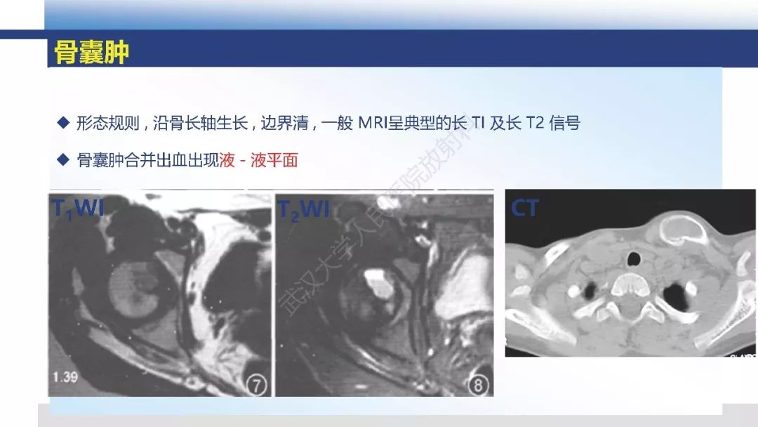 【病例】胫骨良性纤维组织细胞瘤1例X线MR