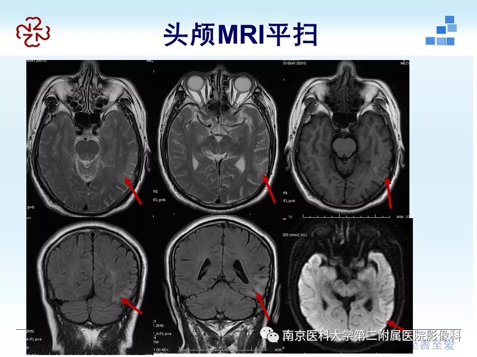 【PPT】脑静脉窦血栓合并脑实质损害的MRI影像学特征