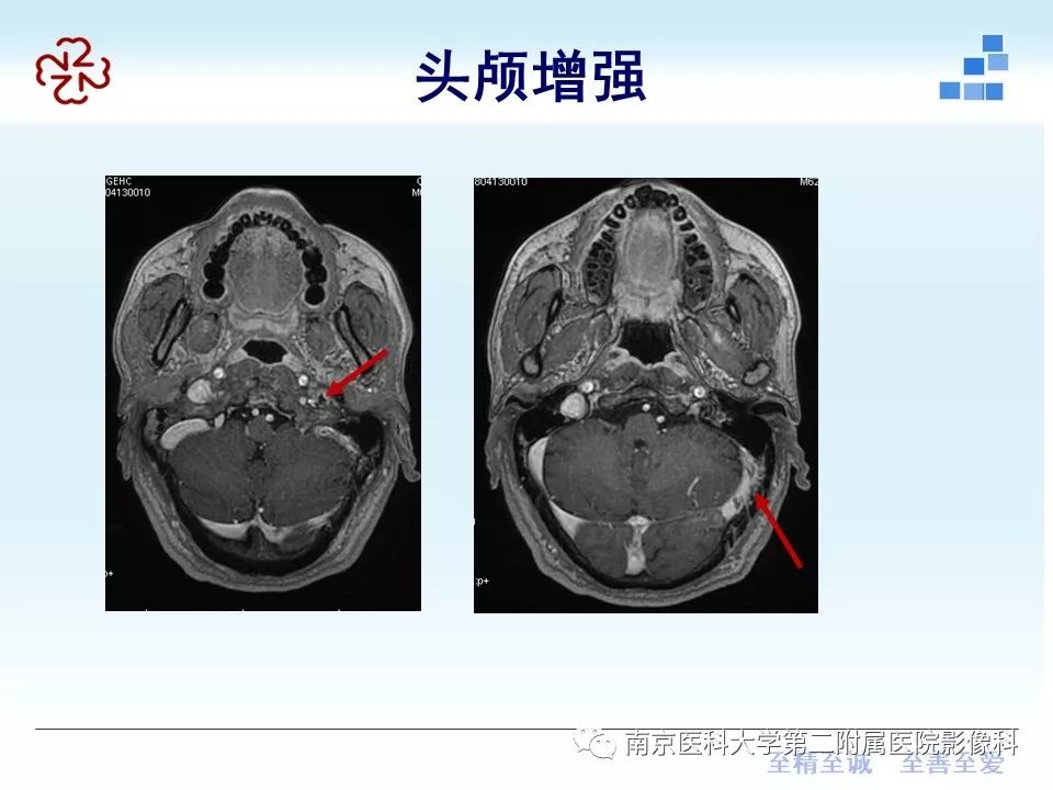 【PPT】脑静脉窦血栓合并脑实质损害的MRI影像学特征