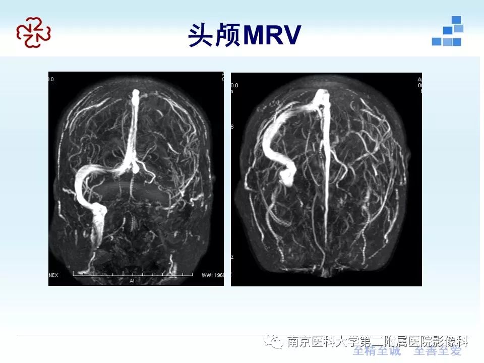 【PPT】脑静脉窦血栓合并脑实质损害的MRI影像学特征