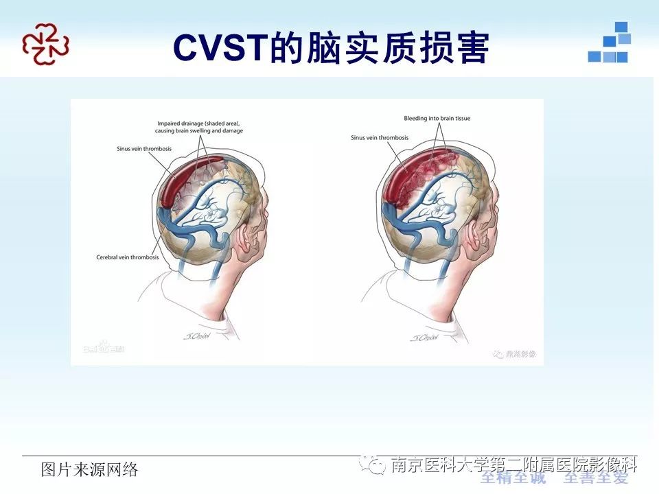 【PPT】脑静脉窦血栓合并脑实质损害的MRI影像学特征