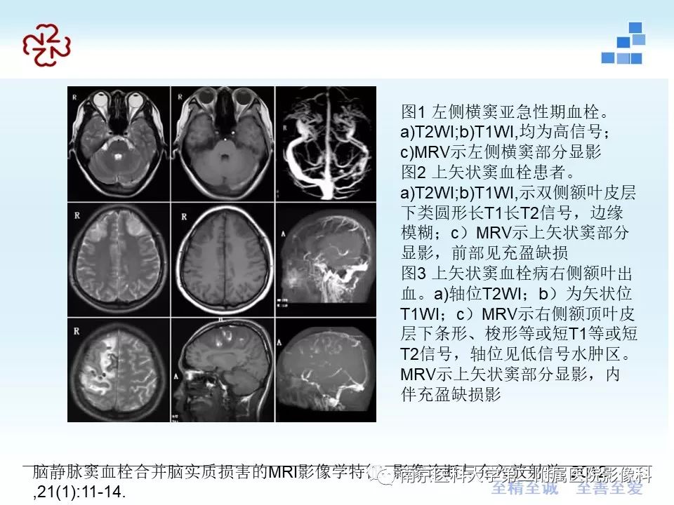 【PPT】脑静脉窦血栓合并脑实质损害的MRI影像学特征