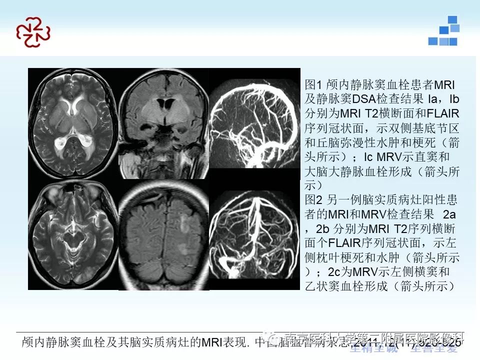【PPT】脑静脉窦血栓合并脑实质损害的MRI影像学特征