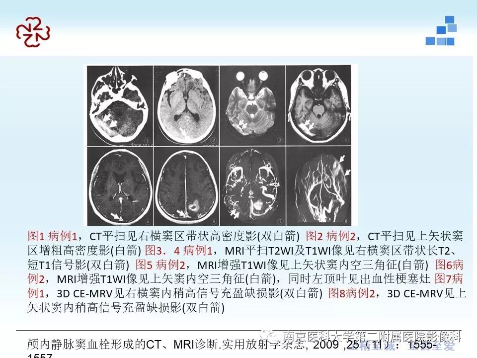 【PPT】脑静脉窦血栓合并脑实质损害的MRI影像学特征