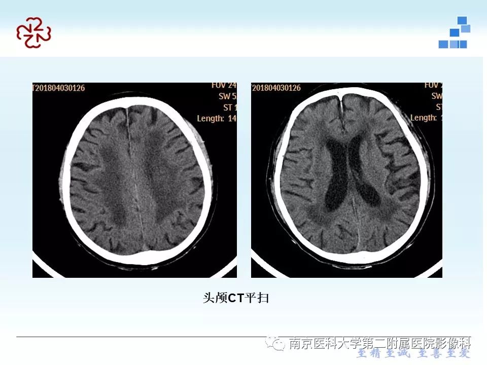 【PPT】脑白质疏松症