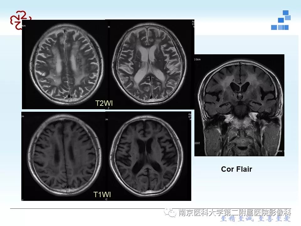 【PPT】脑白质疏松症
