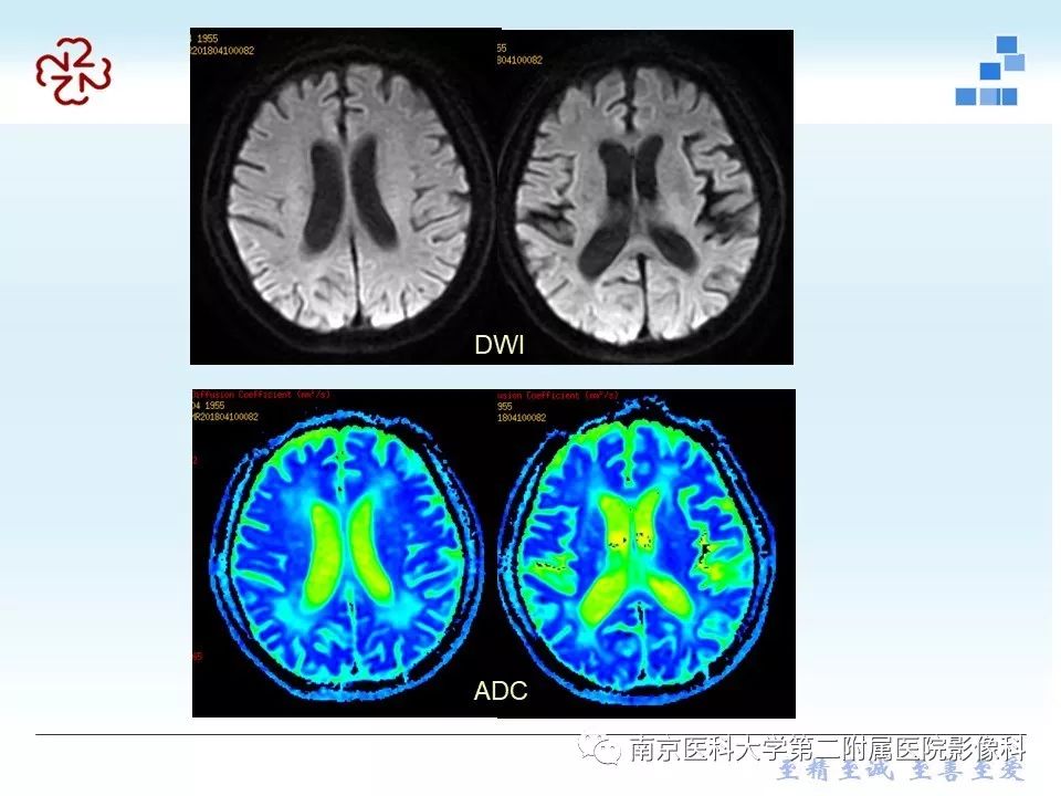 【PPT】脑白质疏松症