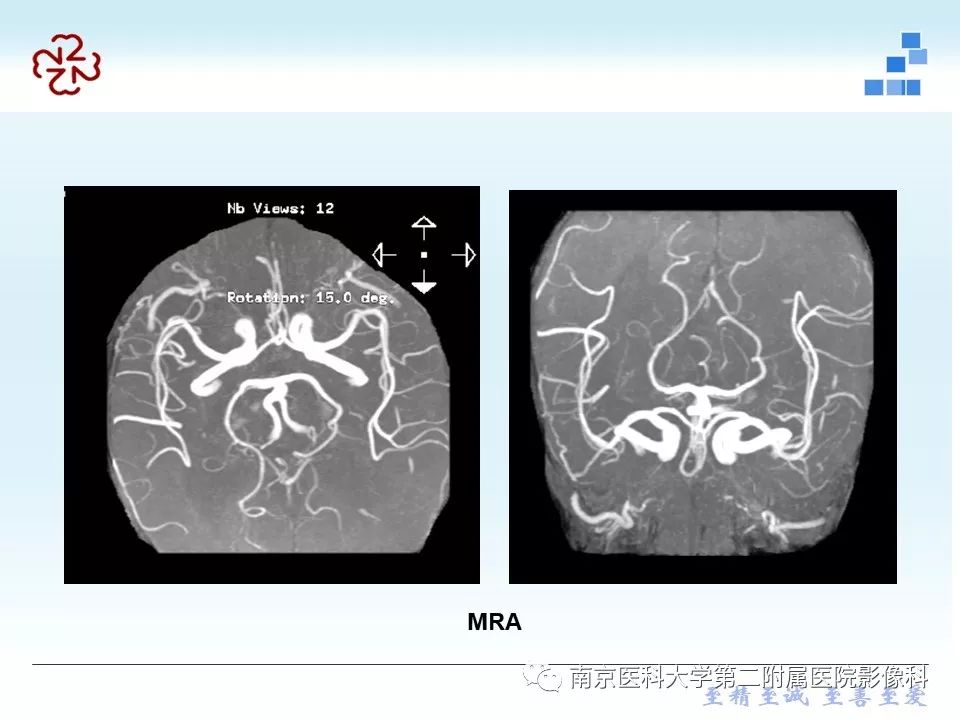 【PPT】脑白质疏松症