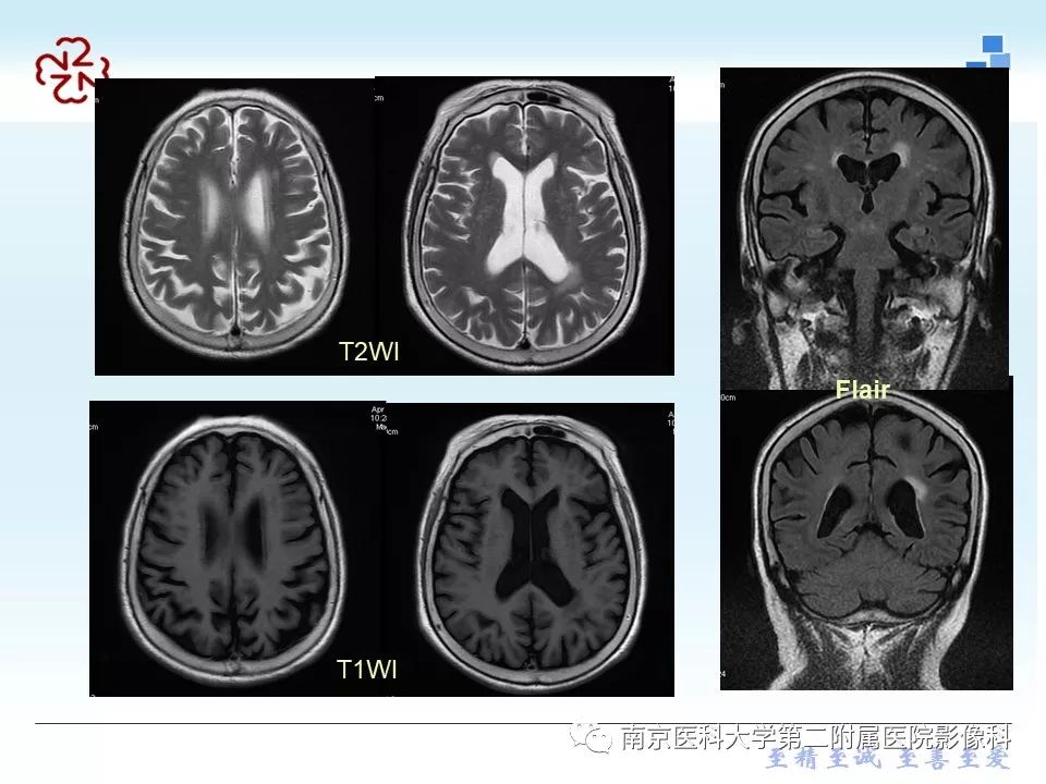 【PPT】脑白质疏松症