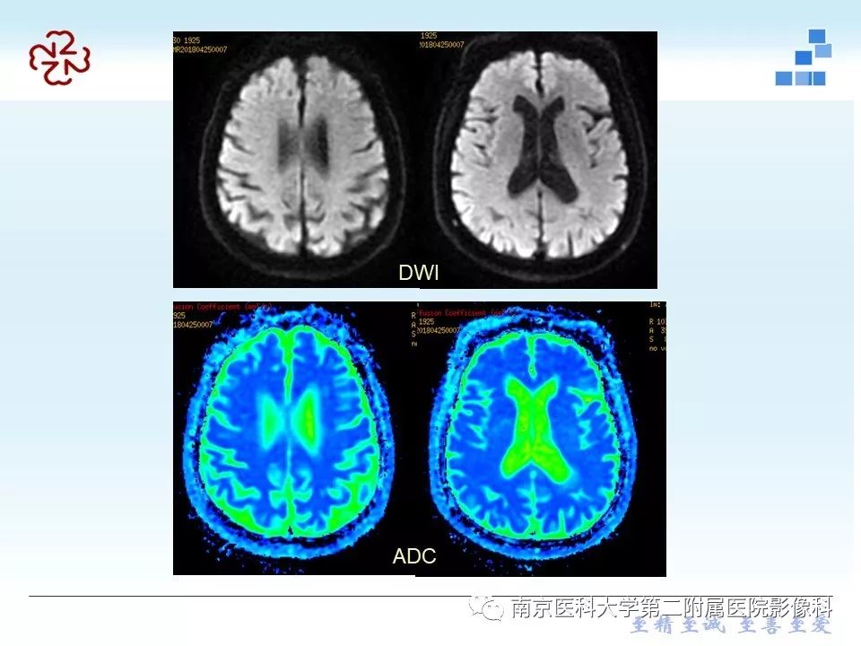 【PPT】脑白质疏松症