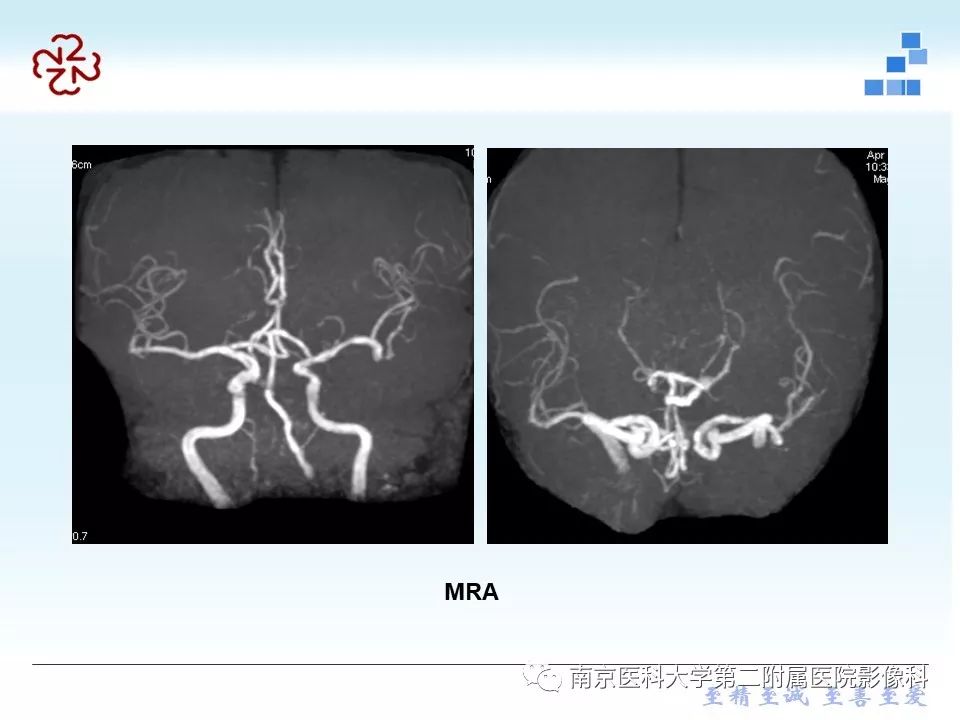 【PPT】脑白质疏松症