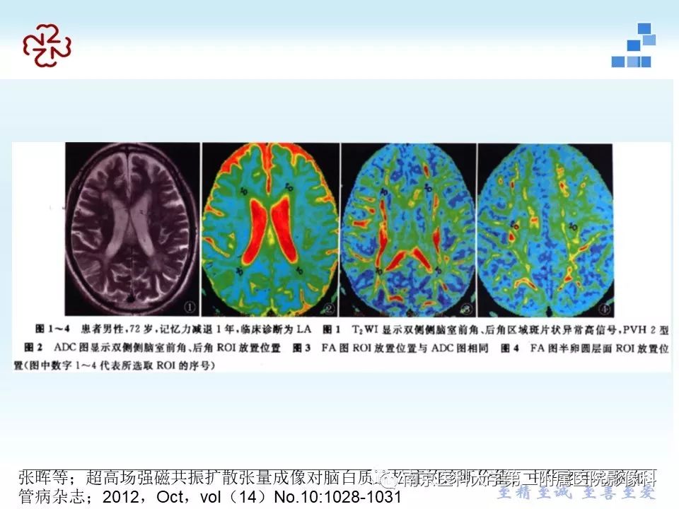 【PPT】脑白质疏松症