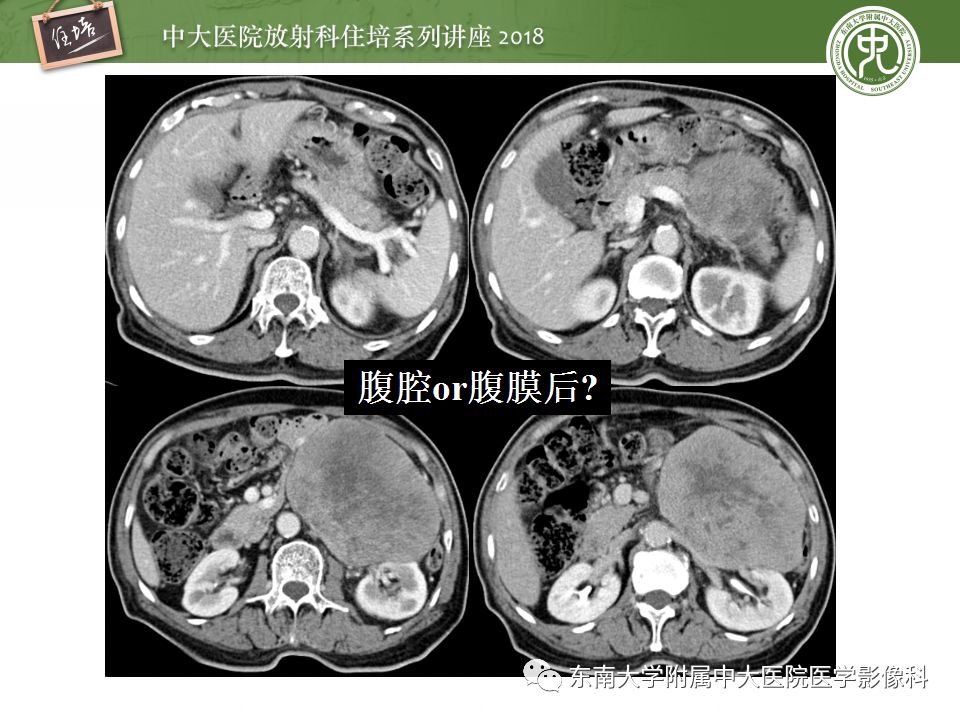 【PPT】中腹部基于器官和影像特点的鉴别诊断