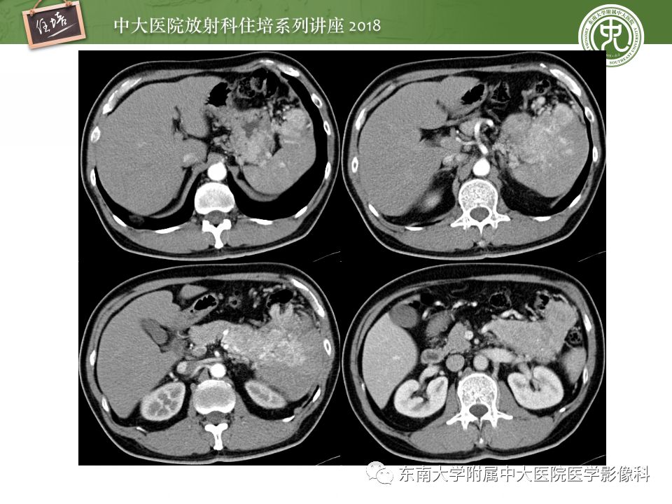 【PPT】中腹部基于器官和影像特点的鉴别诊断