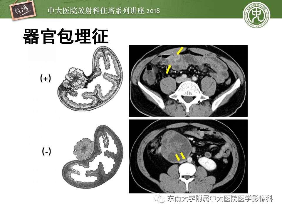 【PPT】中腹部基于器官和影像特点的鉴别诊断
