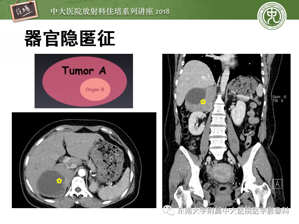 【PPT】中腹部基于器官和影像特点的鉴别诊断